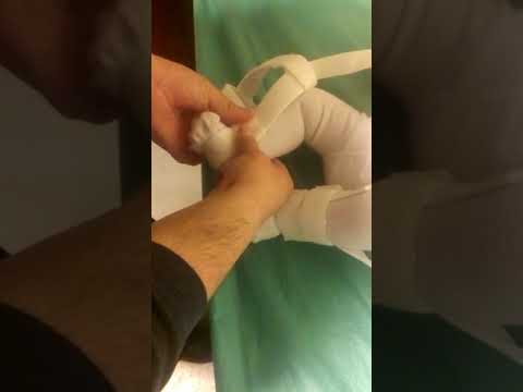 Bebeklerde Kalça Çıkıklığı - Pavlik Bandajı Takma Videosu - (3 Aylık Sol Kalça Alfa 48 Derece)