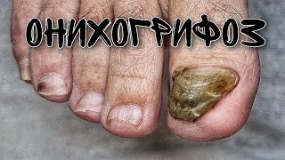 Онихогрифоз / Травма ногтя / Коготь / Обработка ногтя