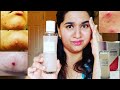 HONEST REVIEW OF WATERMELON GLOW PHA+BHA PORE TIGHT TONER! ITCHY AND PAINFUL PIMPLES! GLOW RECIPE!