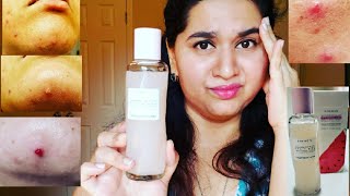 HONEST REVIEW OF WATERMELON GLOW PHA+BHA PORE TIGHT TONER! ITCHY AND PAINFUL PIMPLES! GLOW RECIPE! by Aishwarya Overby 21,114 views 3 years ago 6 minutes, 50 seconds