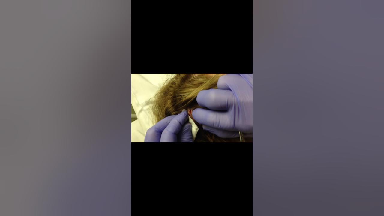 My sebaceous cyst removal YouTube