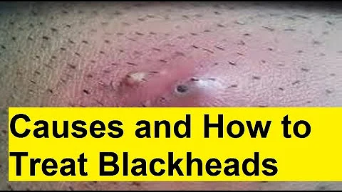 causes and how to remove blackheads