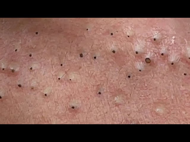 Unusual Popping Huge Blackheads and Pimples