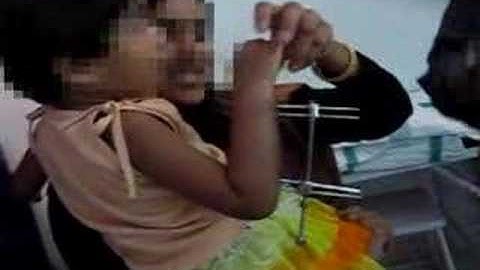 With External Fixator