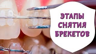 Снятие брекетов. Результат до и после брекетов | Доктор Д | Дентал ТВ