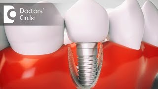 What should one eat after a Dental Implant surgery? - Dr. Mohammed Fayaz Pasha