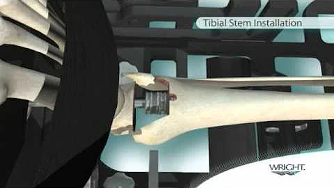 INBONE Total Ankle Replacement