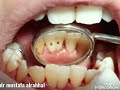 tooth gemination,teeth fusion التصاق الاسنان السفلية