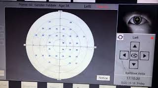 Ophthalmic Automatic Visual Field Analyzer Visual Field Eye Exam Screening Computer Perimeter