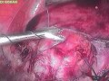 Total laparoscopic hysterectomy for a round ligament fibroid