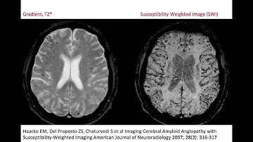 68. CAA, Cerebral Amyloid (micro) Angiopathy; vascular dementia, micro bleeds, superficial siderosis