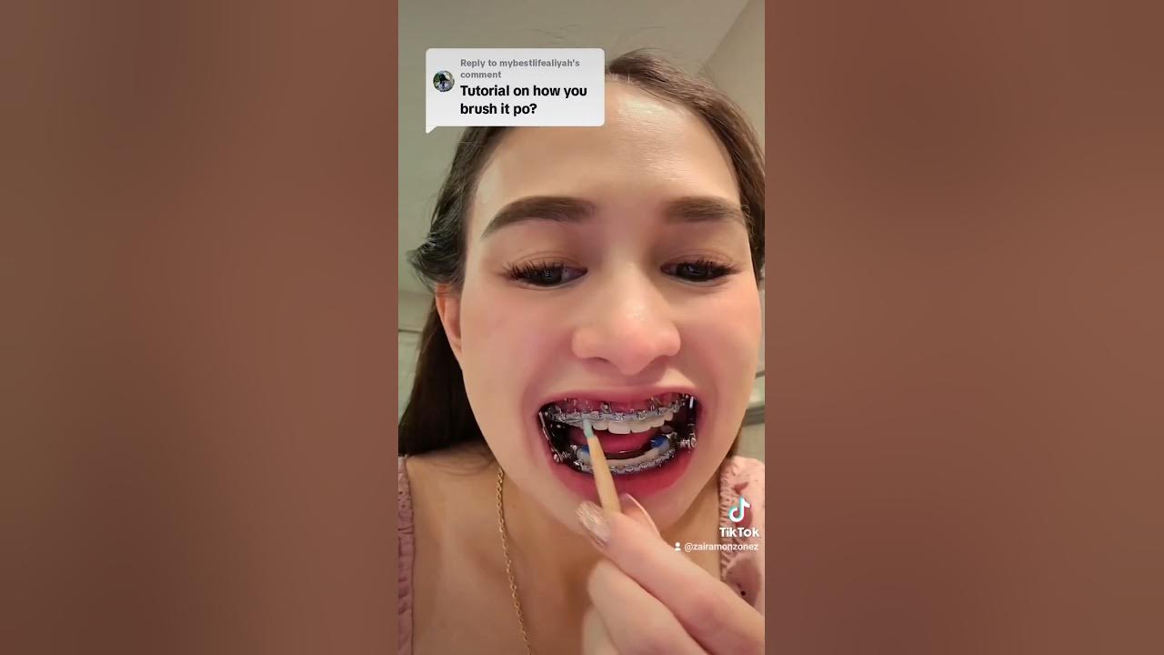 Tutorial on how I brush my Teeth ! Brace w/HERBST APPLIANCE YouTube