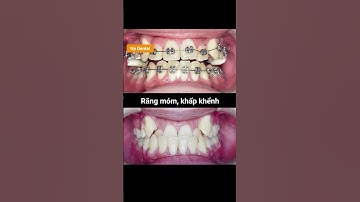 Cận cảnh quá trình thay đổi răng móm, khấp khểnh sau 3 năm