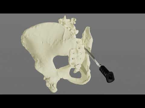 OrthoFundamentals Hammerless Posterior Allograft SI Joint Fusion Surgery Animation