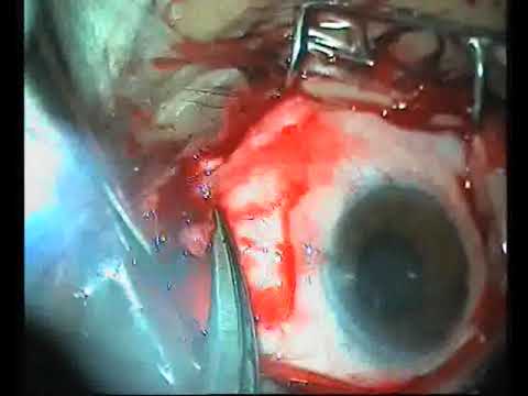 Optic nerve sheath decompression step by step , step 3 , suturing and retracting the MR muscle