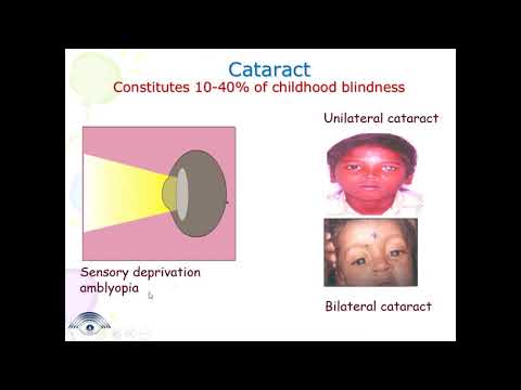 بچوں میں آنکھوں کی عام بیماریاں - ڈاکٹر کے وینا