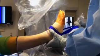 Simple 1-Step Ankle Arthroscopy Distraction