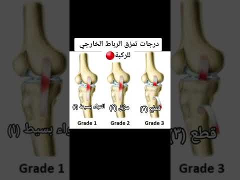 تمزق الرباط الخارجي للركبة