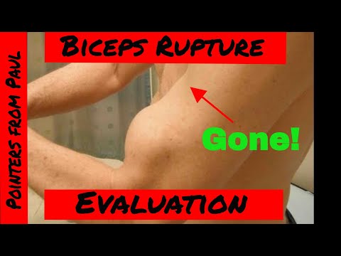 Biceps rupture tests\Hook test with Paul Marquis PT