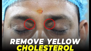 Say Goodbye to Yellow Cholesterol Forever | Remove Yellow Cholestero l Awish Clinic | #viral