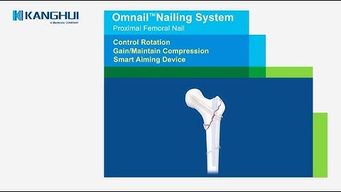 Kanghui Omnail | Proximal Femoral Nailing System