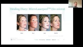 Sciton ProFractional Laser for Sun Damage | Dr. Jonathan Bielfield