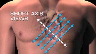 Parasternal Short Axis Views