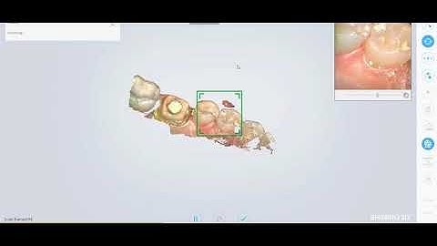 Case setup and imaging / Shining3D Aoralscan IOS