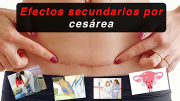 ¿Afectan los estornudos a los puntos de la cesárea?