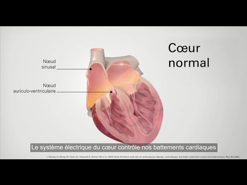 Vidéo: 3 façons d'identifier la fibrillation auriculaire