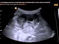 Опухоль почки новорожденного (злокачественная рабдоидная опухоль)