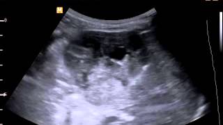 Опухоль почки новорожденного (злокачественная рабдоидная опухоль)