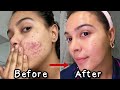 How I Got Rid of My Acne *3 products that changed my life* | NataliesOutlet