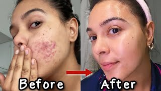 How I Got Rid of My Acne *3 products that changed my life* | NataliesOutlet screenshot 5