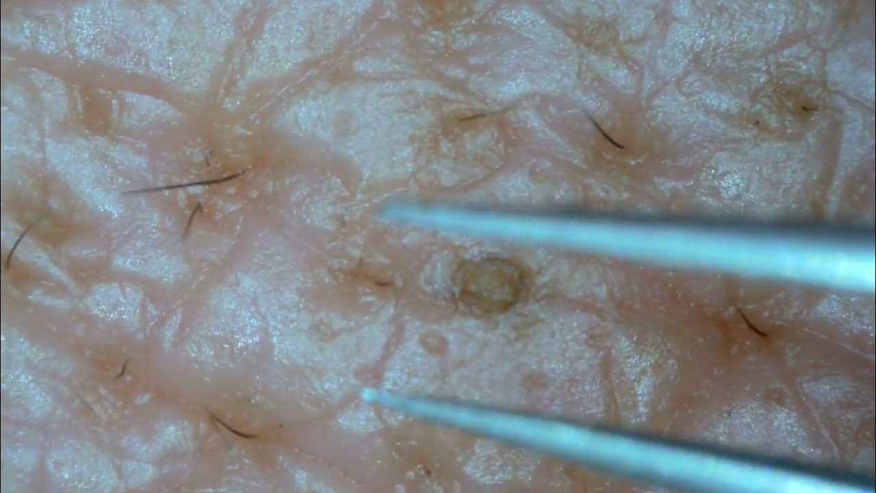 0222 keratin plug removal forehead YouTube