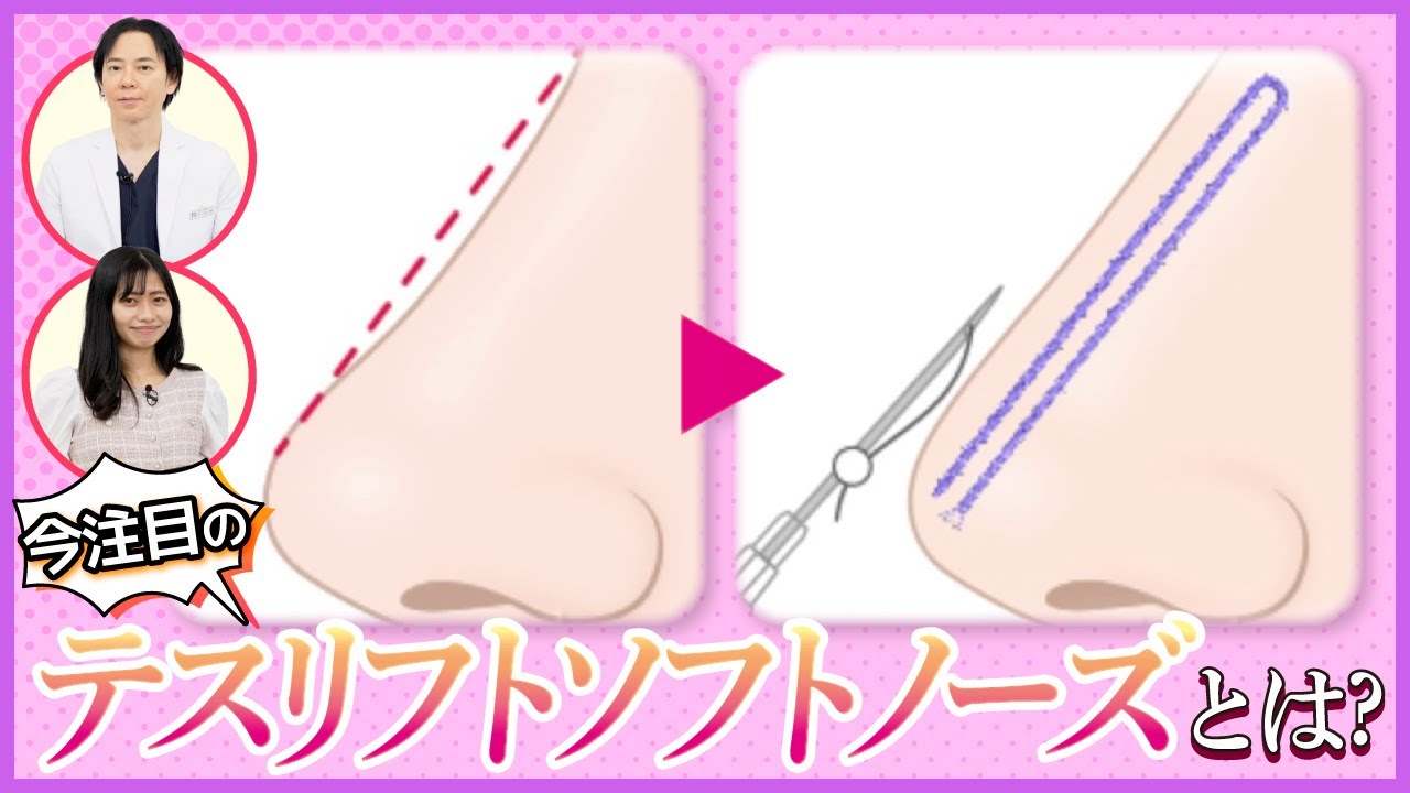 【糸リフト最新情報】テスリフトノーズって？