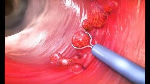 Colonscopic Polypectomy | Cold & hot biopsy- polyp| Snare technique | Dr Rams Medical Coding Academy