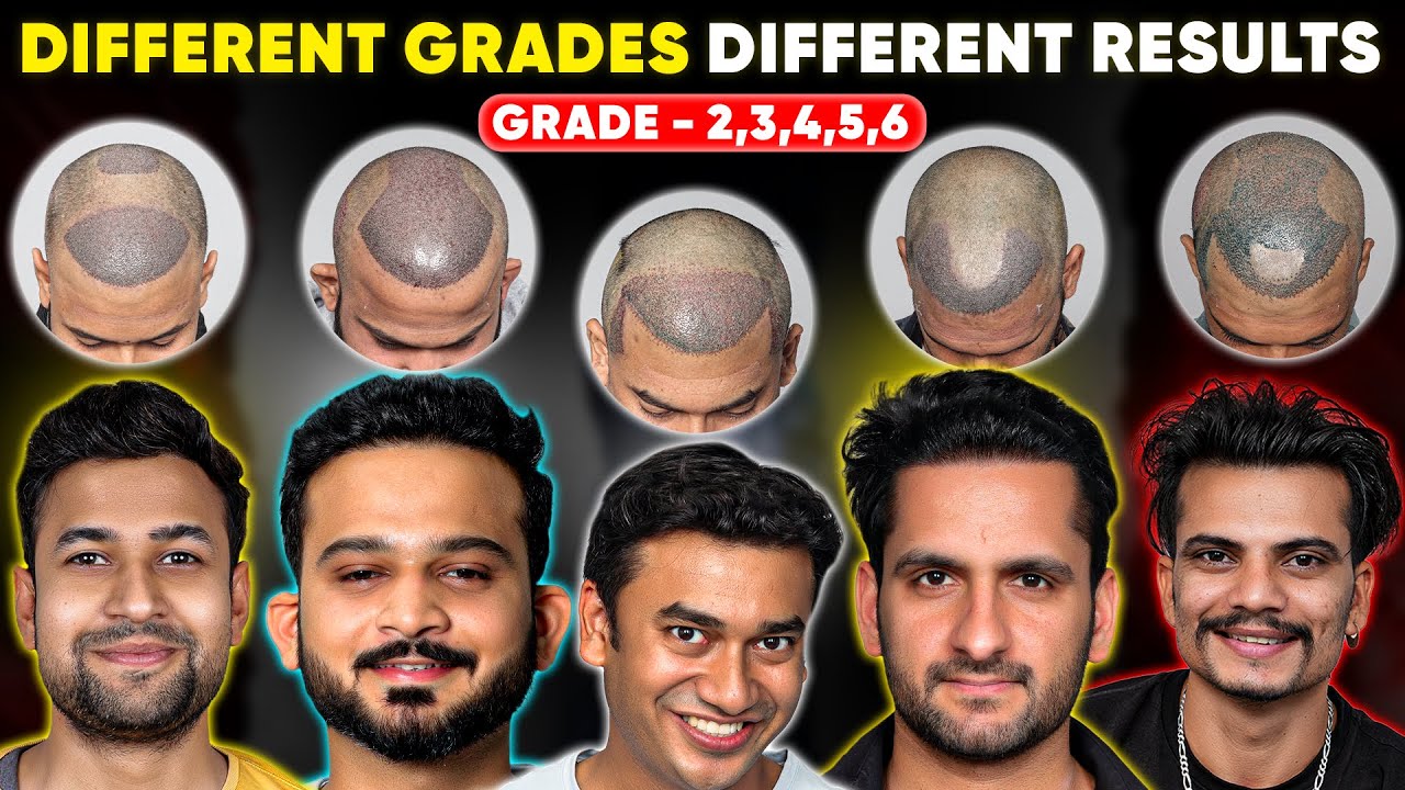 Hair transplant in  Lucknow | Best Results & Cost of Hair Transplant in  Lucknow