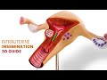 Intrauterine Insemination IUI For Pregnancy Step By Step Guide 3D Animation Intrauterine Insemination IUI For Pregnancy Step By Step Guide 3D Animation
