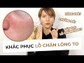 KHẮC PHỤC LỖ CHÂN LÔNG TO - Đầy đủ kiến thức từ cấu trúc, cách khắc phục, sai lầm thường gặp.