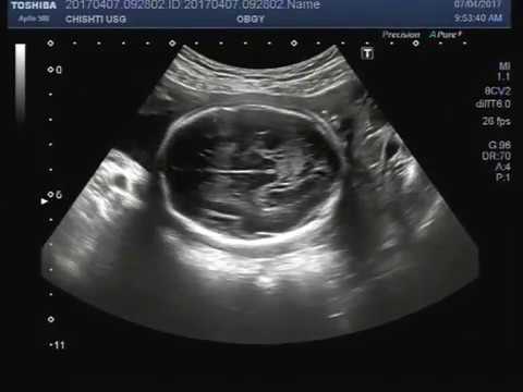 Ultrasound video showing dilated lateral as well as 3rd ventricles of