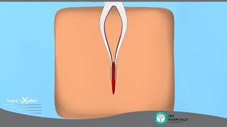 IBS Hospital | Minimally Invasive Spine Surgery | Advanced Techniques for Back & Neck Pain Relief