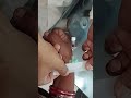 IV Cannula Pass technique 18G#viralvideo #youtubeshorts #unfrezzmyaccount #emergency #nurselife