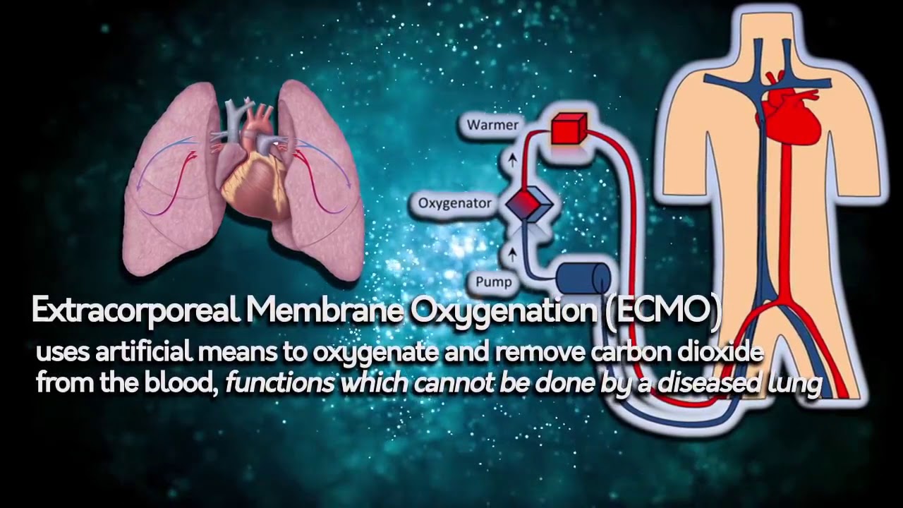 The First Reported Severe Leptospirosis Survival in the Philippines using ECMO Technology
