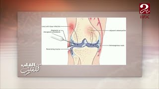 بالصور ... تعرف على أنواع وأعراض الالتهاب الروماتيزمي والمفاصل والذئبة الحمراء