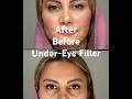 Fresh eyes, fresh life! Under-eye filler = instant glow ✨ #UnderEyeFiller #glowup