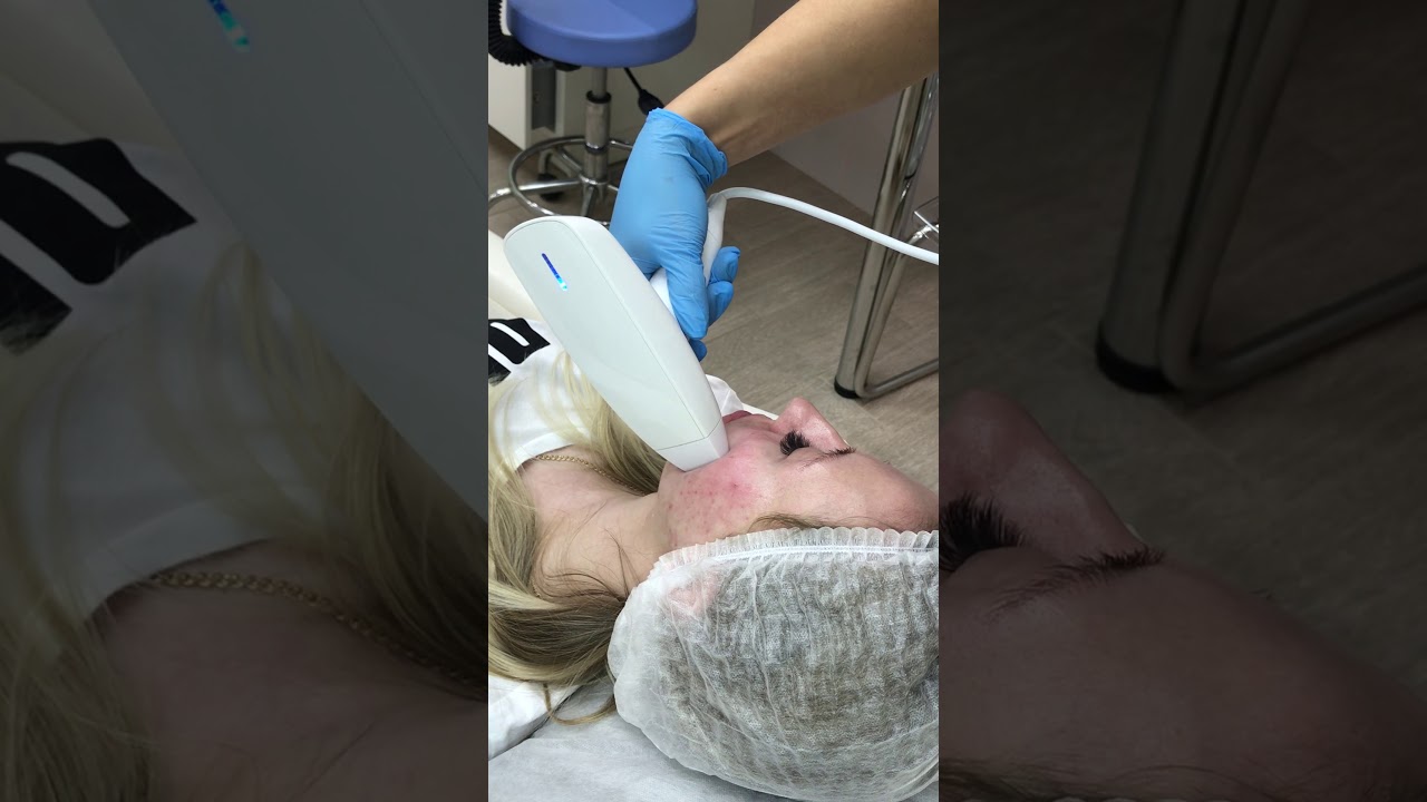 VENUS VIVA проведение процедуры