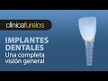 Una completa visión general de los implantes dentales