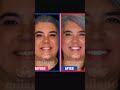 Smile Makeover With 20 Emax Veneers Patient From Spain Shorts