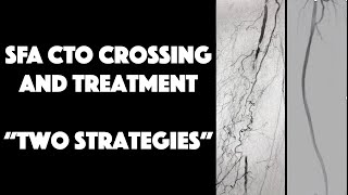 SFA CTO Crossing Technique & 2 Treatment Strategies